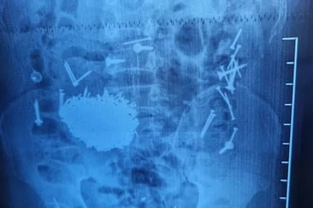 Uzbek Doctors Remove 200g of Nails from Patient's Stomach