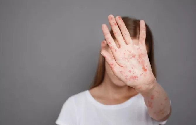 Uzbekistan Identifies Over 200 Suspected Measles Cases