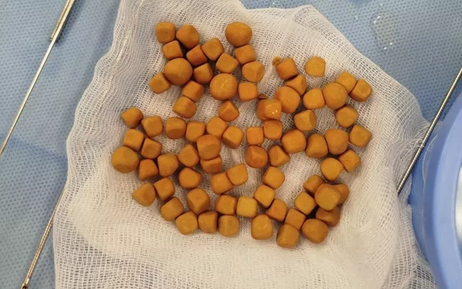 Kazakh Doctors Remove 80 Bladder Stones in Rare Surgery