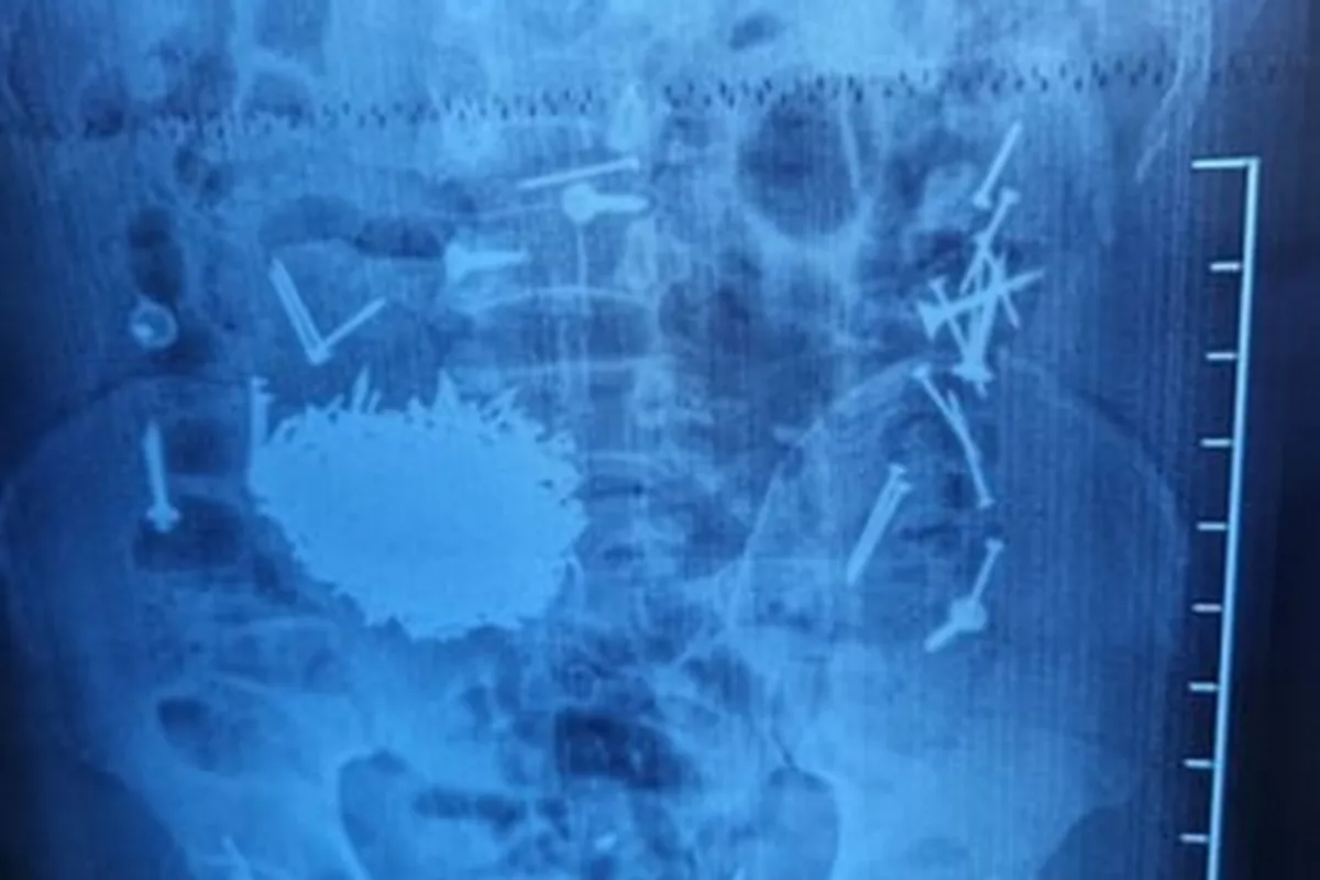 Uzbek Doctors Remove 200g of Nails from Patient's Stomach
