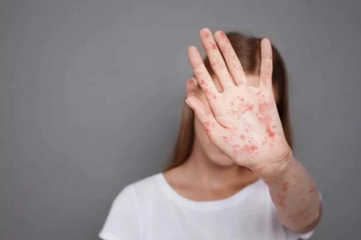 Uzbekistan Identifies Over 200 Suspected Measles Cases
