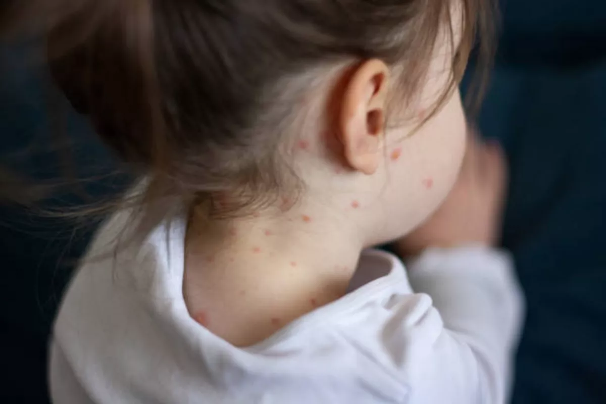Kyrgyzstan’s Measles Outbreak: 30% of Cases in Children Under 1 Year Old