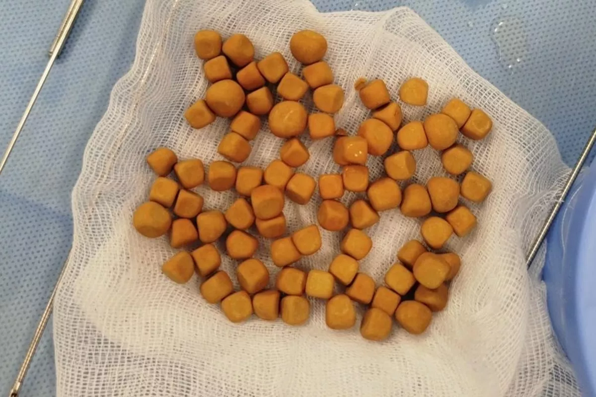 Kazakh Doctors Remove 80 Bladder Stones in Rare Surgery