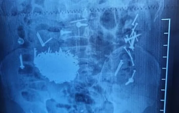 Uzbek Doctors Remove 200g of Nails from Patient's Stomach