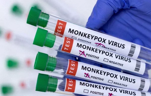 Is Monkeypox Becoming a Concern in Russia Again?