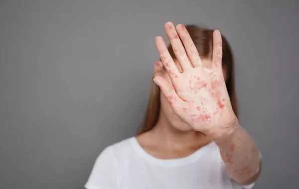 Uzbekistan Identifies Over 200 Suspected Measles Cases