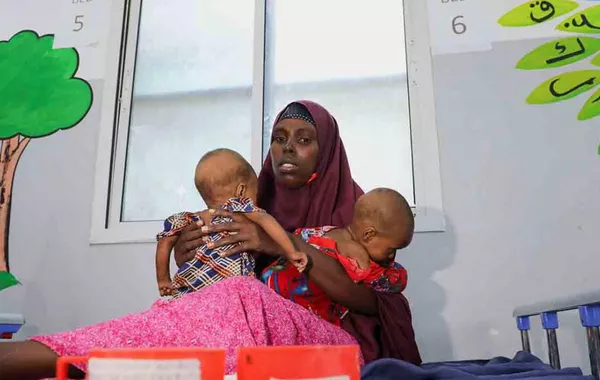 Somalia's Malnourished Children Hit Hard by Iran War
