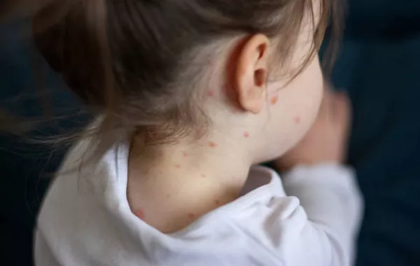 Kyrgyzstan’s Measles Outbreak: 30% of Cases in Children Under 1 Year Old