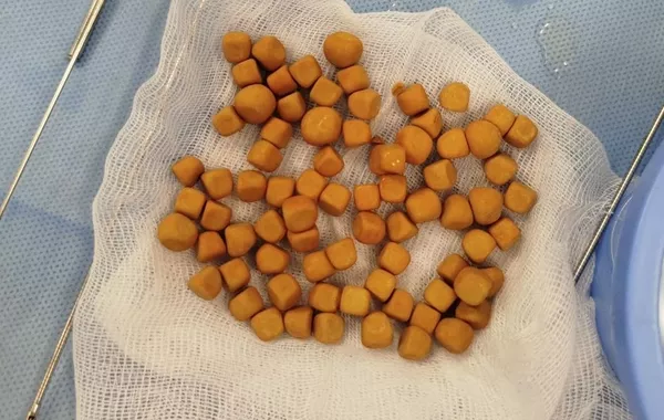 Kazakh Doctors Remove 80 Bladder Stones in Rare Surgery